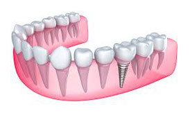 Closing the Gap with Dental Implants