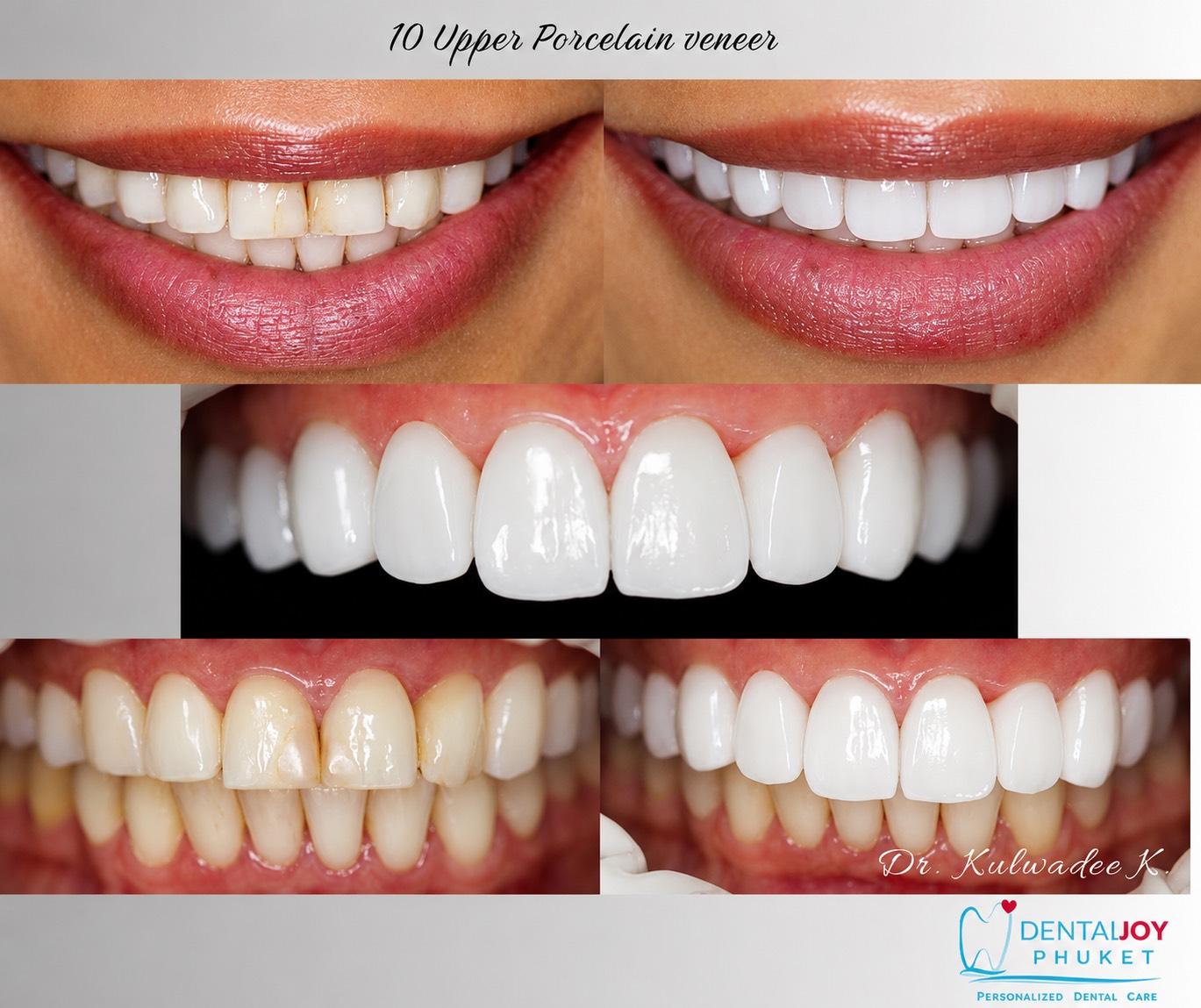 Dental Veneers