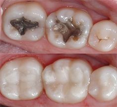 Composite fillings