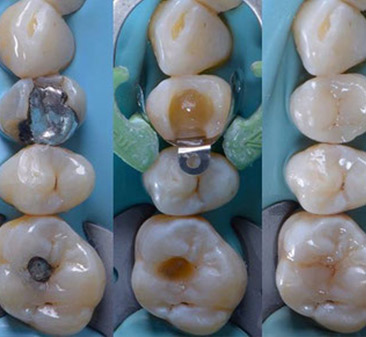 Composite fillings