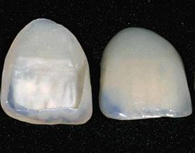 Dental Veneers