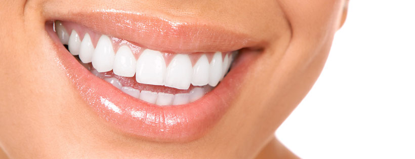 Dental Veneers