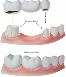 Dental Bridge