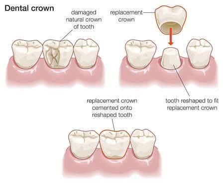 Dental Crowns