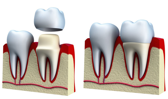 Dental Crowns